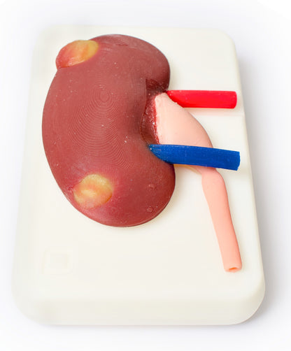 Multi-Tumor Kidney