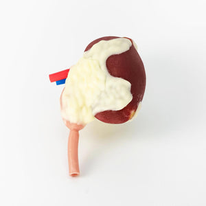 Multi-Tumor Kidney