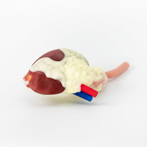 Multi-Tumor Kidney