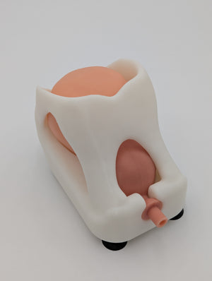 Simple Prostatectomy