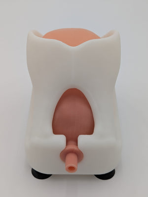 Simple Prostatectomy